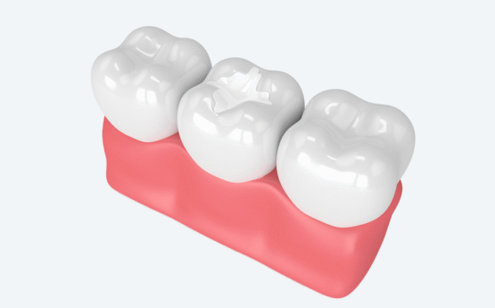 Caring for Your Composite Fillings: Essential Oral Hygiene Tips