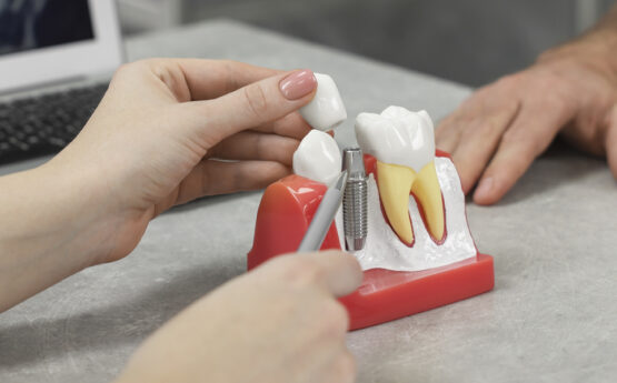 Single Tooth Dental Implants: A Precision Solution for Missing Teeth