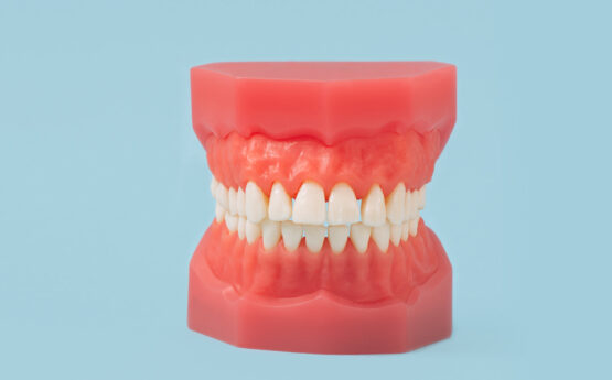 Adapting to New Dentures: What to Expect During the Adjustment Period