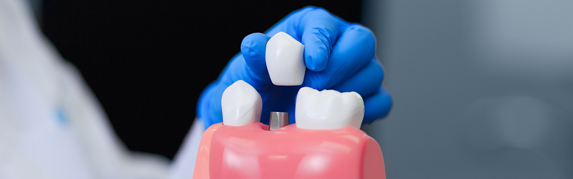 Why Dental Implants Serve as the Gold Standard for Tooth Replacement
