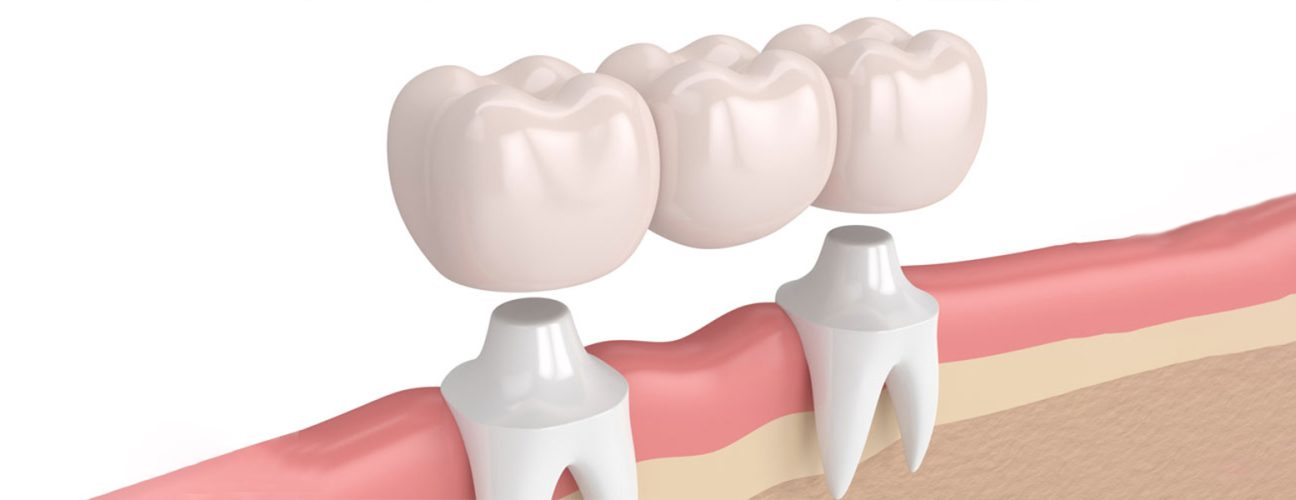 Can a Dental Crown Fix a Broken or Cracked Tooth?