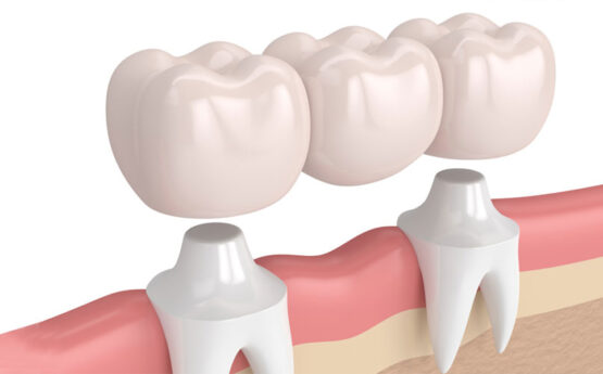 Can a Dental Crown Fix a Broken or Cracked Tooth?