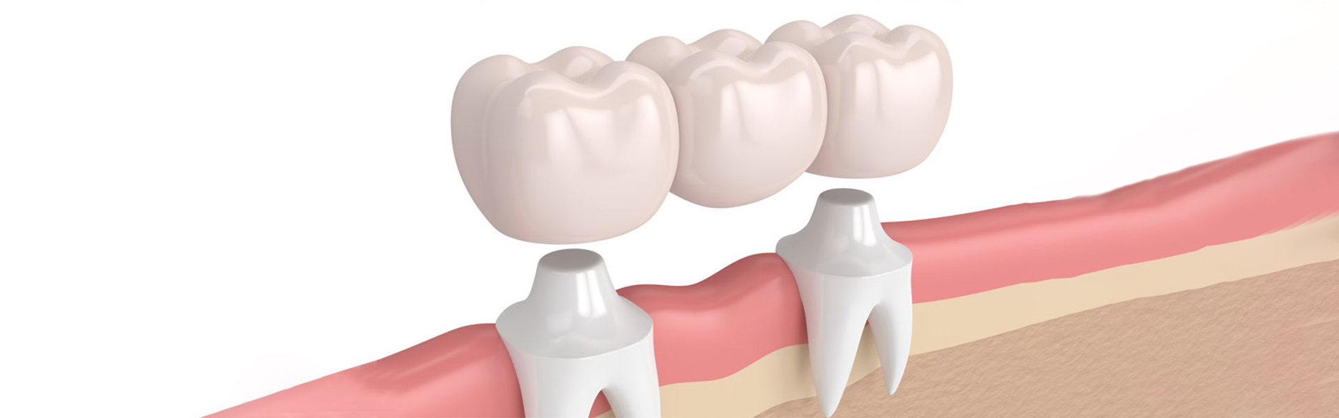 Can a Dental Crown Fix a Broken or Cracked Tooth?