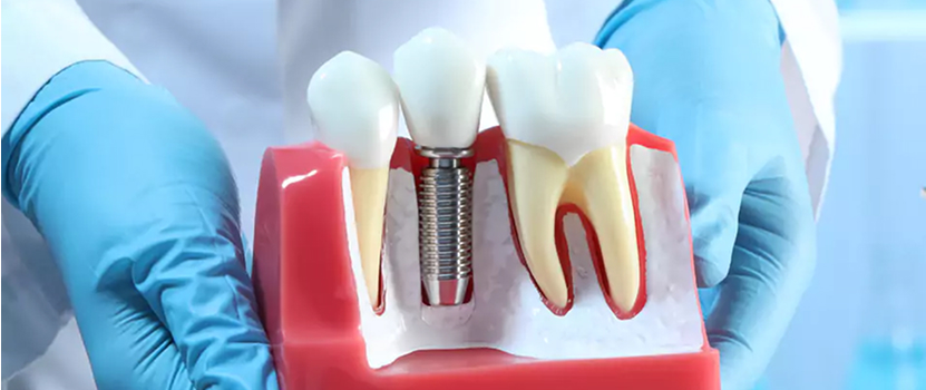 Implants
