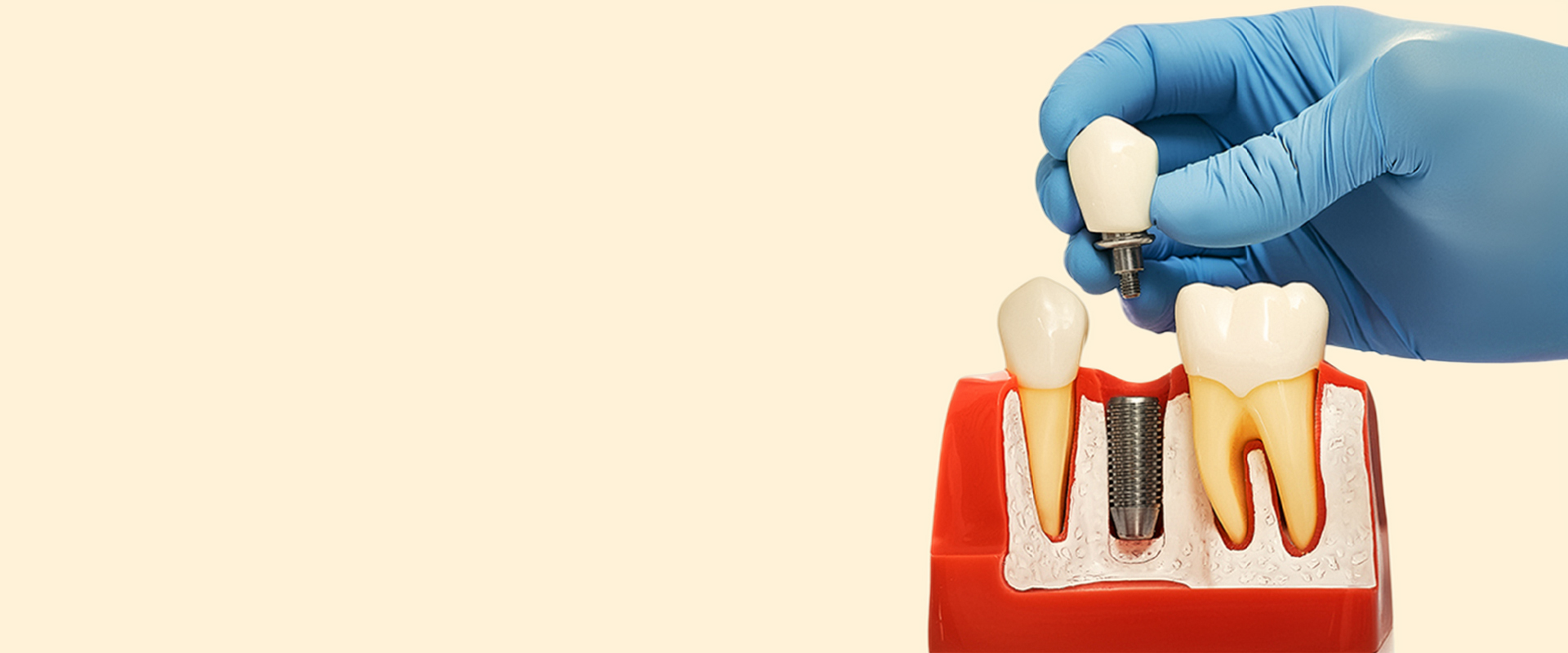 Free Implants Consultation