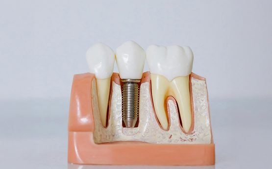 Can Dental Implants Help With Facial Aesthetics? The Surprising Benefits Beyond Your Smile
