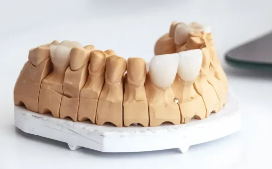 How to Care for Your Veneers: Daily Habits for Lasting Results