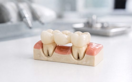 How Modern Dental Bridges Look Natural and Feel Comfortable